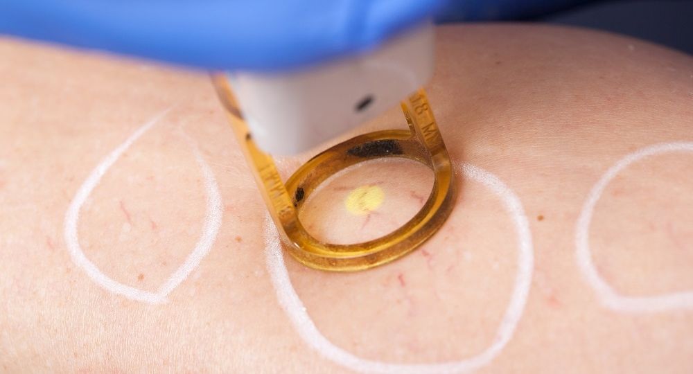“Pre-treatment consultation for laser thread vein removal at Angel Skin Lab, Cheadle, Stockport”