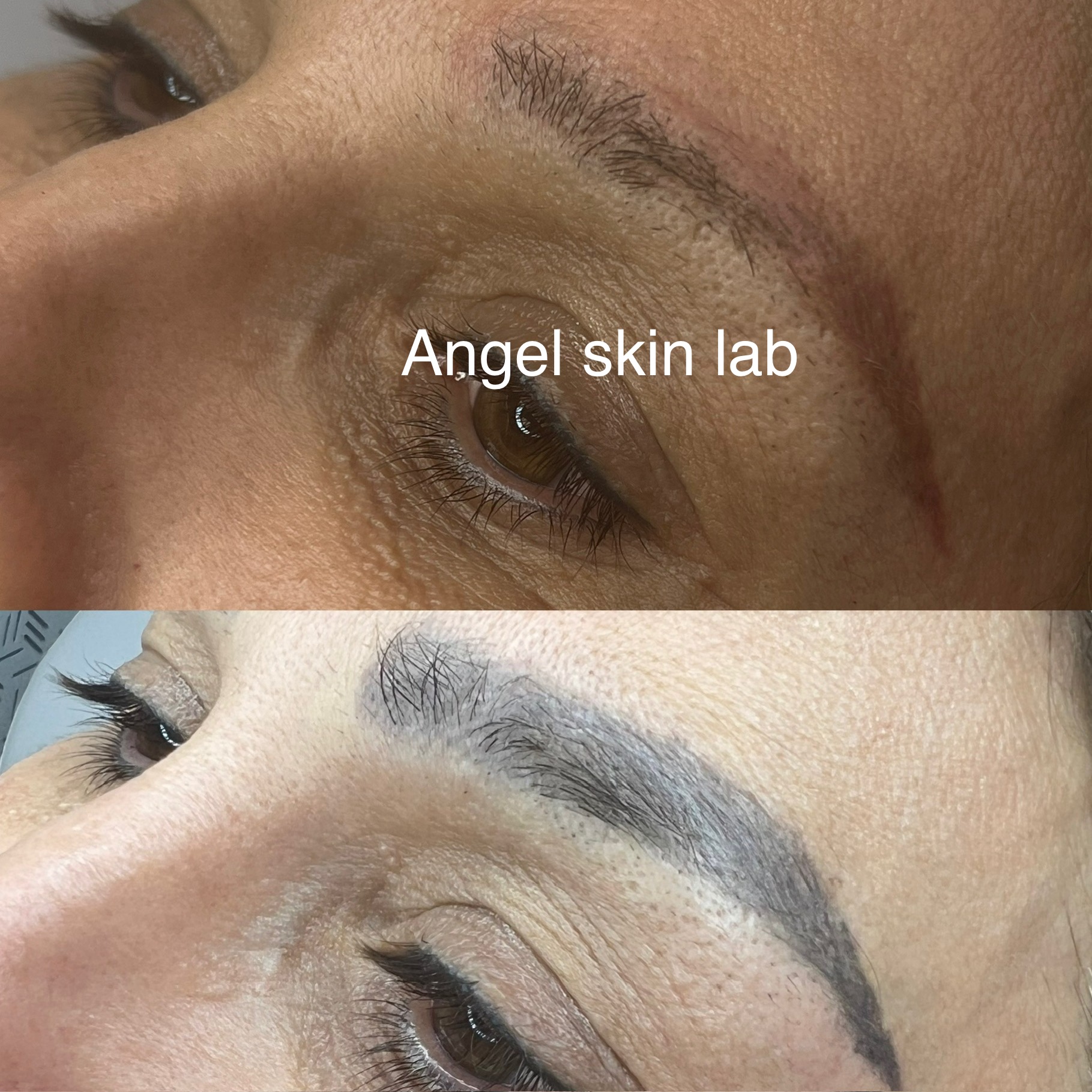 Laser tattoo removal treatment in Cheadle at Angel Skin Lab near Stockport