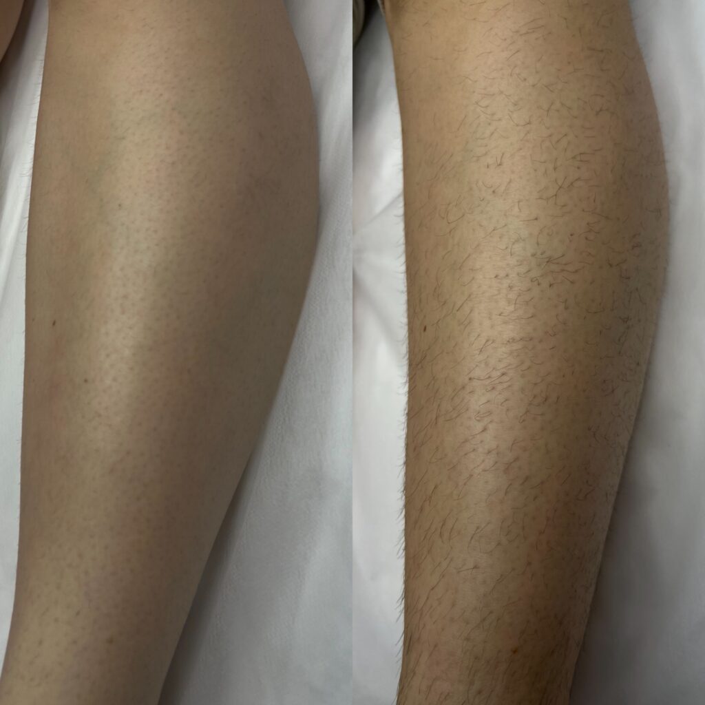 Laser hair removal consultation at Angel Skin Lab in Cheadle