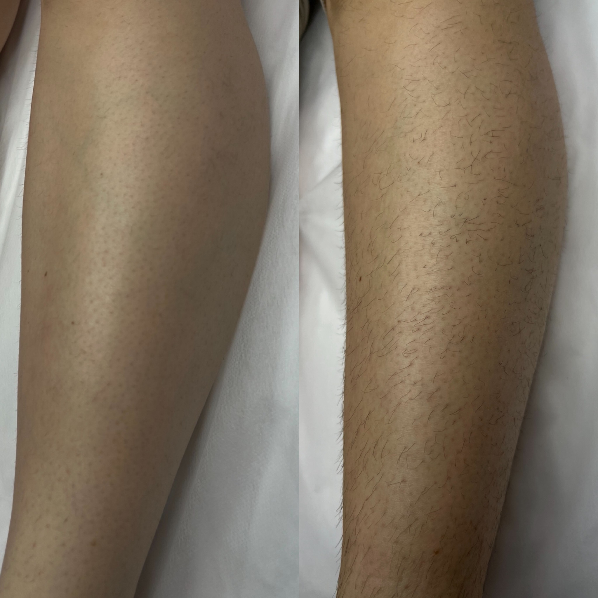 Laser hair removal consultation at Angel Skin Lab in Cheadle