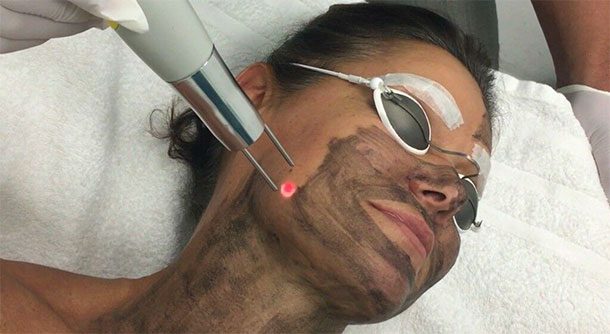 Laser carbon peel treatment in Cheadle for oily and congested-looking skin