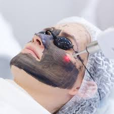 carbon laser facial treatment in Cheadle