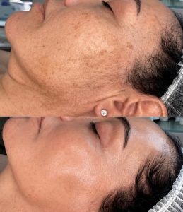 Skin pigmentation consultation at Angel Skin Lab in Cheadle