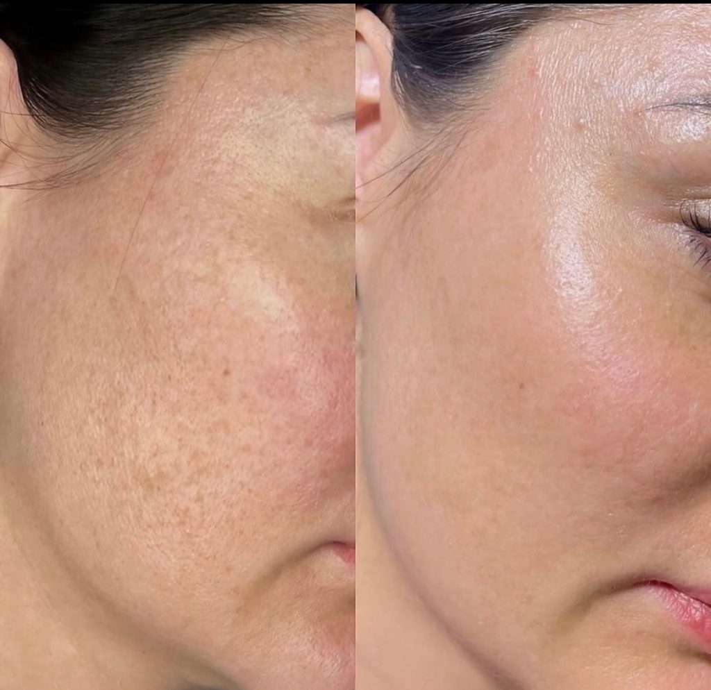 Laser pigmentation treatment consultation in Cheadle for uneven skin tone and sun spots