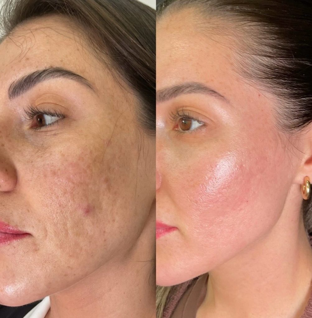 Skin pigmentation consultation at Angel Skin Lab in Cheadle