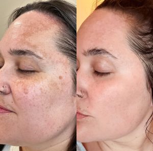 "Skin consultation for pigmentation, melasma and sun spots at Angel Skin Lab, Cheadle, Stockport"