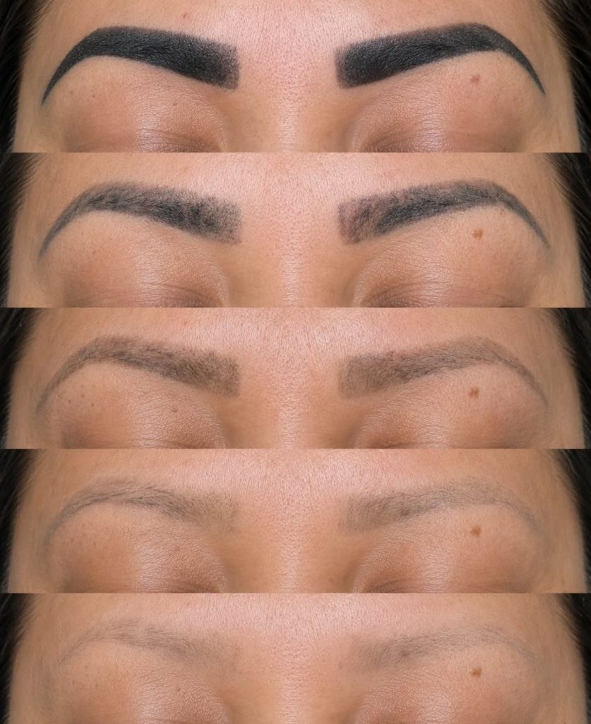 laser tattoo removal cheadle