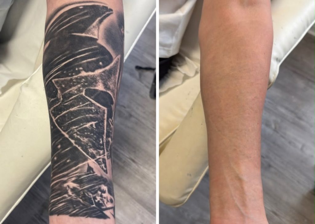 laser tattoo removal cheadle