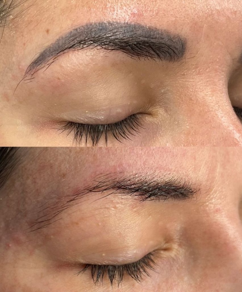 laser tattoo removal cheadle