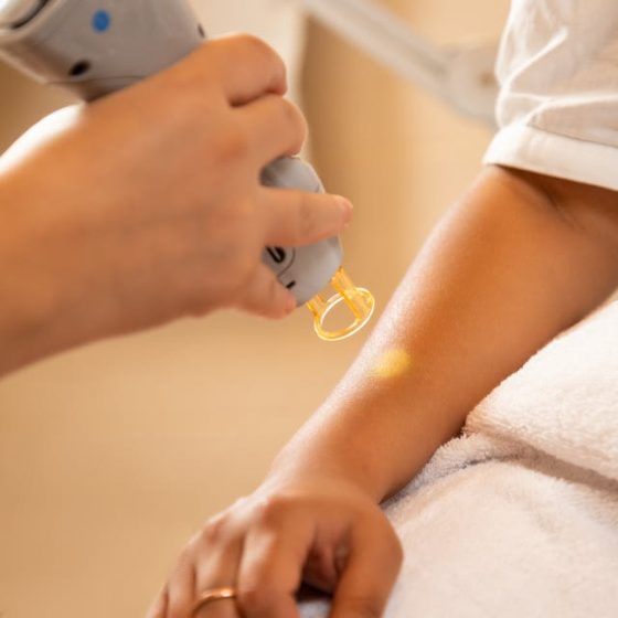 laser hair removal