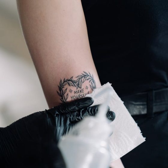 laser tattoo removal