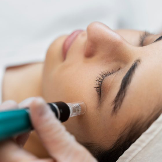 microneedeling